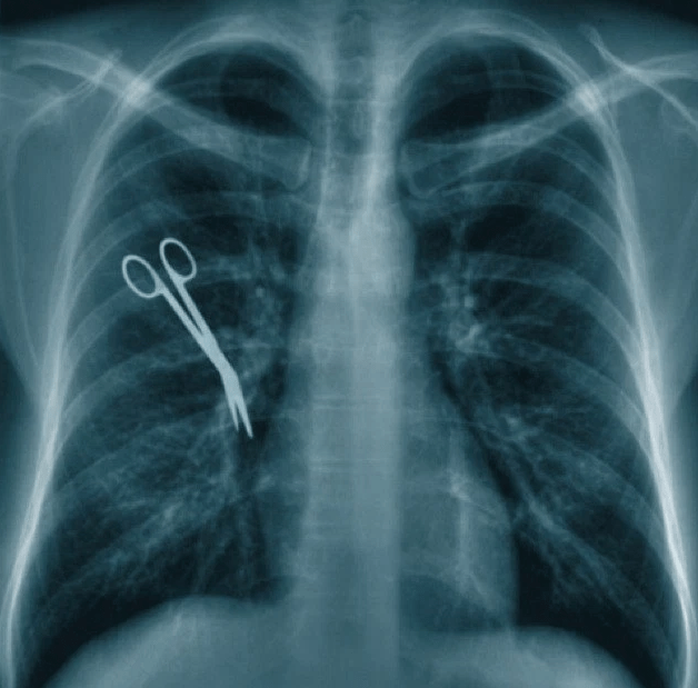 Those aren't supposed to be there! Scissors in the stomach, simia pre-settlement funding